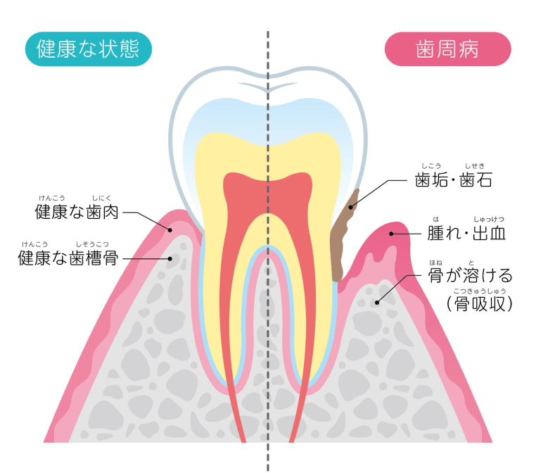 歯周病でお困りの方へ