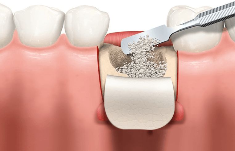 歯周組織再生療法について